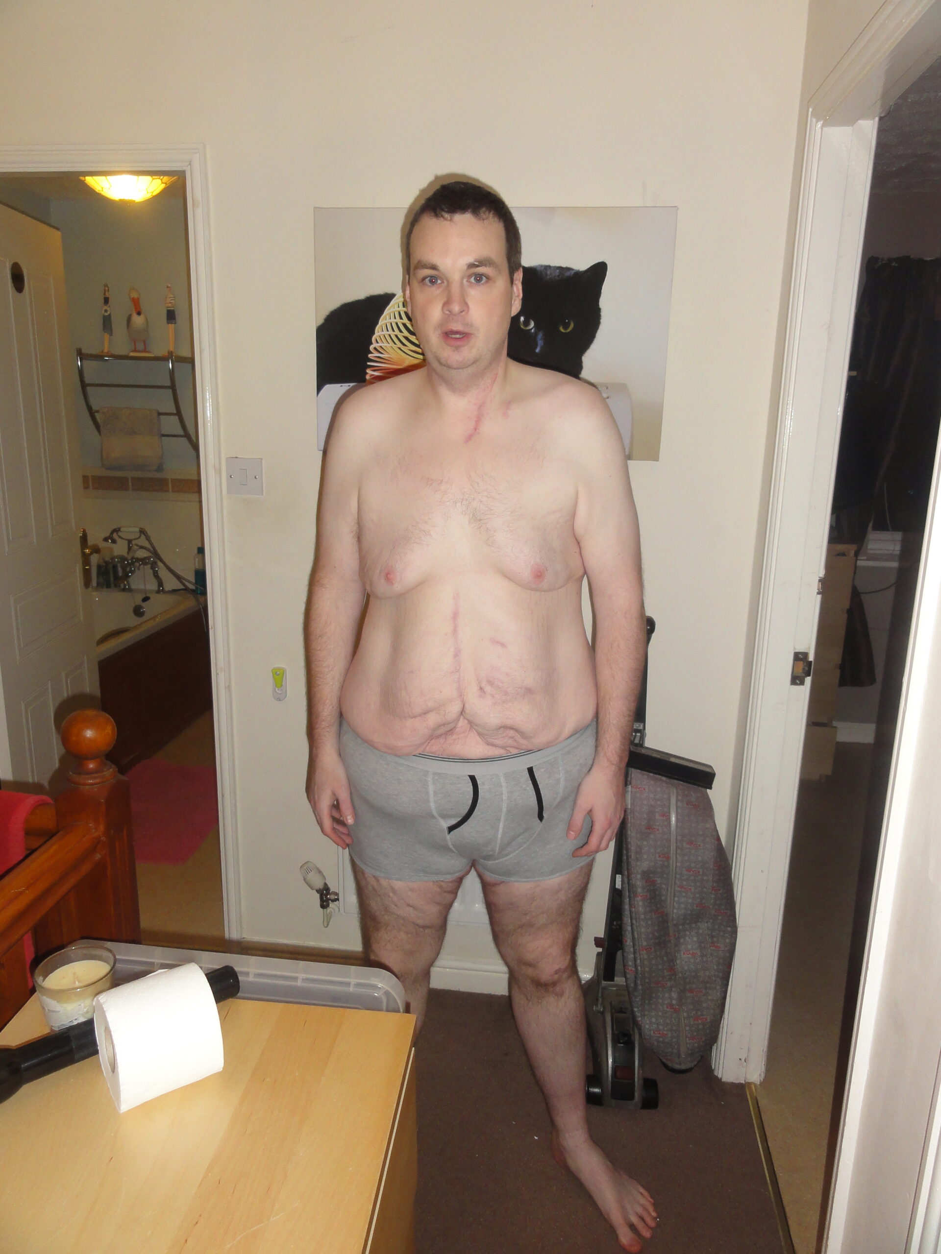 2013-10-26 – 3 Years Post-Surgery